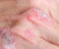 boli de piele pe articulațiile degetelor