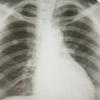 Campanie de informare cu privire la cancerul pulmonar