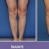 Implantul in gambe, noul trend in materie de chirurgie estetica