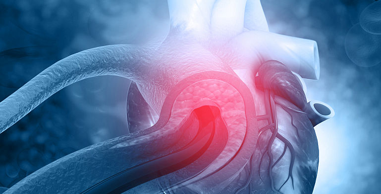Ectazia de aorta - cauze, simptome si tratament