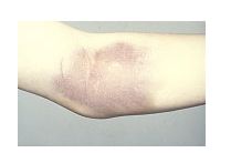 tratamentul hemartrozei genunchiului cu hemofilie