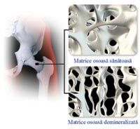 cum se tratează medicamentul articular osteoporoză