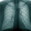 Tuberculoza – in continuare o problema majora de sanatate publica 