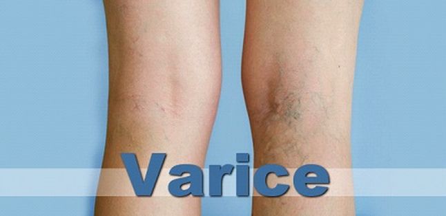 Scleroterapia varicelor