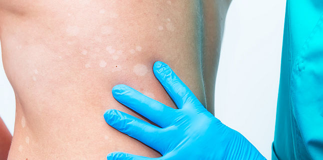 Vitiligo: Cauze, simptome si tratament