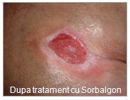 escare