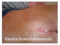 escare