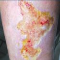ulcer de gamba