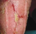 vindecare_permafoam
