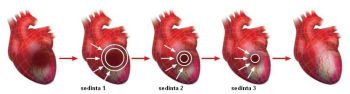 cardioefort