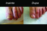 Cel mai bun tratament pentru ciuperca piciorului – micoza unghiei