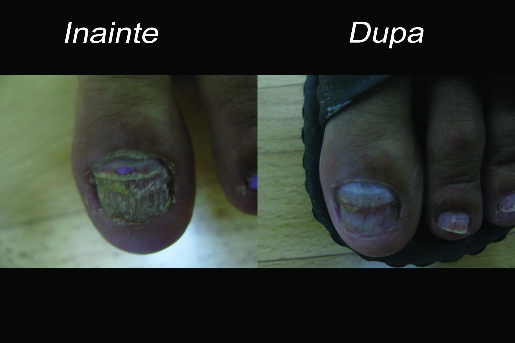 Cel mai bun tratament pentru ciuperca piciorului – micoza unghiei