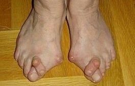artrita reumatoidă a degetelor mari de la picioare