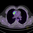 diagnosticare cancer
