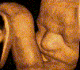 Hard+Soft pentru imagine ecografica 3D