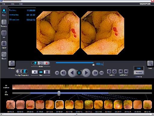 Sistem capsula endoscopica