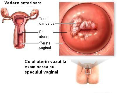 Cancerul cervical