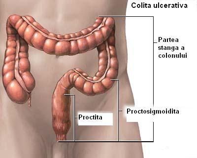 proctosigmoidita și prostatita