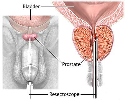 ecografia prostata transrettale chist pe fondul prostatitei