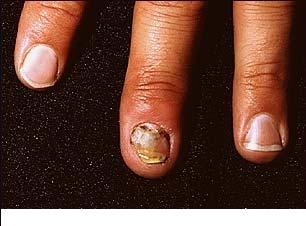 Onicomicoza (Infectia fungica a unghiei)