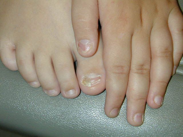 copilul are ciuperca unghiilor de la picioare