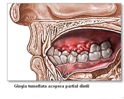 Gingivita - inflamatia gingiei
