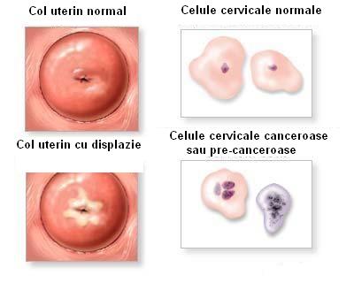 Cancerul cervical - stadializare si tratament
