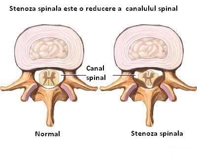 Stenoza spinala cervicala