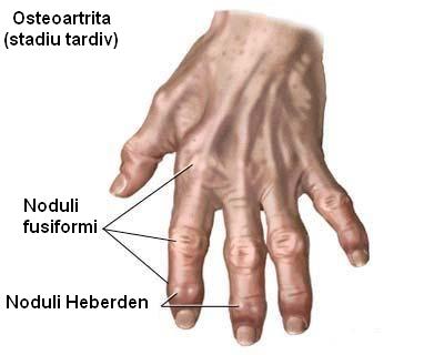 osteoartrita mâinii