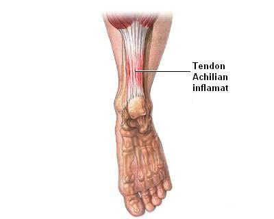 Afectiuni ale tendonului lui Achile