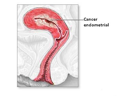 Informatii generale despre cancerul endometrial