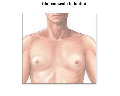 Ginecomastia - hipertrofia glandei mamare la barbat