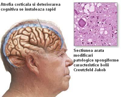 Encefalopatia spongiforma bovina - Boala vacii nebune
