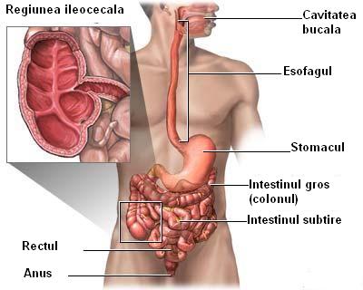 Boala Crohn - inflamatia colonului