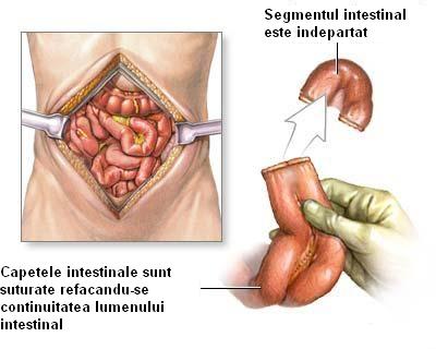 tratament helmint boala crohn
