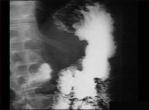Cancer gastric - imagine radiologica