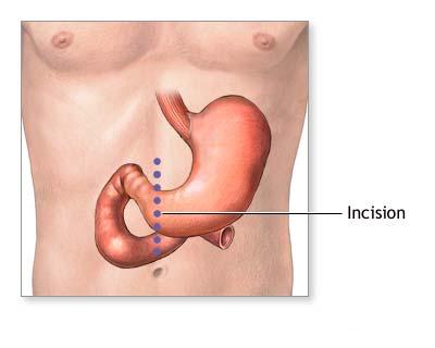 Gastrectomie - inciczie