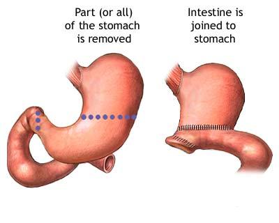 Gastrectomie - procedura