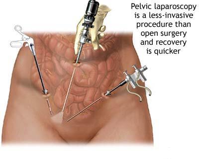 Recenzii de adenom de prostată laparoscopie