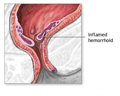 Hemoroizi- Informarea pacientului
