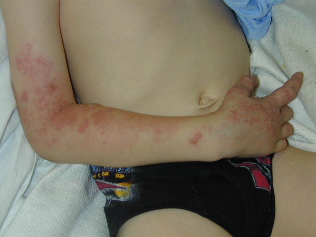 Poze Medicale Zona Zoster