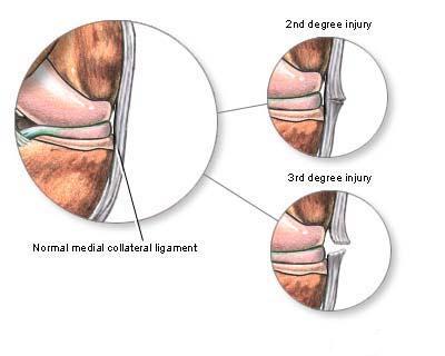 Leziunile ligamentelor colaterale mediale sau laterale ale genunchiului