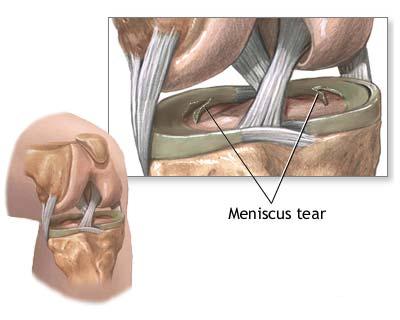 Leziuni ale meniscului de la nivelul articulatiei genunchiului