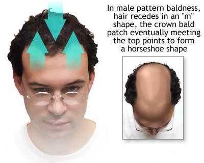 Alopecia - caderea parului, chelia sau calvitia