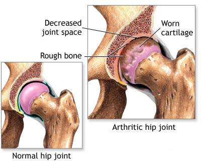ce este artrita reactiva exerciții pentru tratamentul artrozei genunchiului