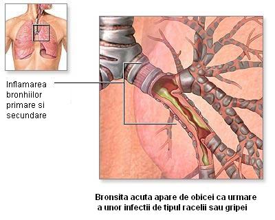 Prostatita acuta bacteriana - secțiunea 2