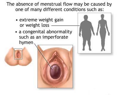 Amenoreea sau lipsa menstruatiei