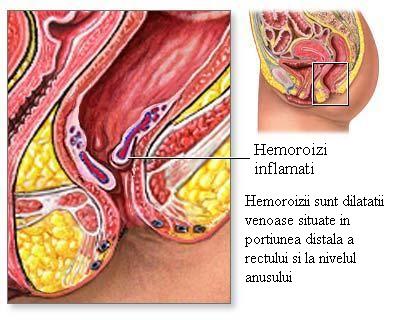 Hemoroizii