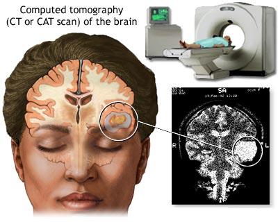 CT cerebral