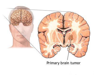 Tumoare cerebrala